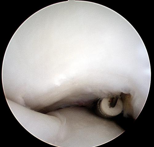annular-ligament-desmotomy