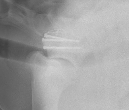 shoulder-fracture