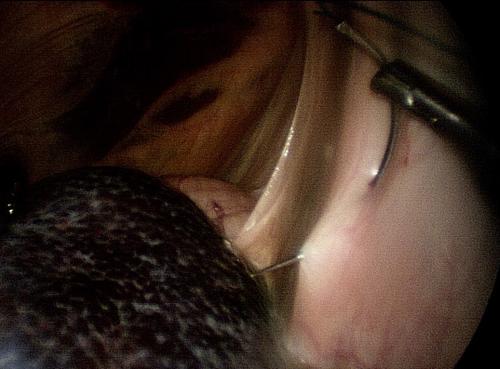 suturing-the-nephrosplenicspace (1)