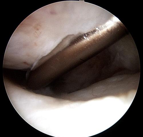 tarsal-sheath-injury
